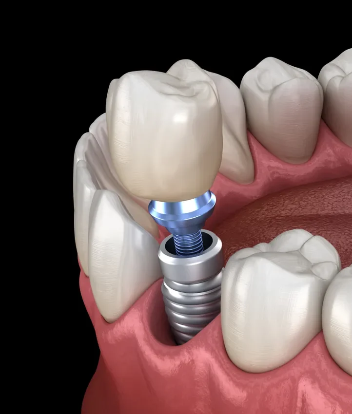 Dental Implants